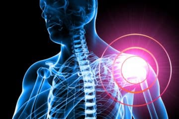 Reverse Shoulder Replacement Surgery