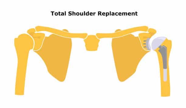 Total Shoulder Replacement