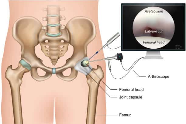 Hip Arthroscopy