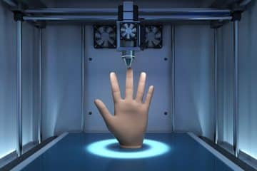 Hand Transplant