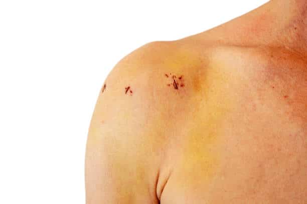 Shoulder Arthroscopy Cost