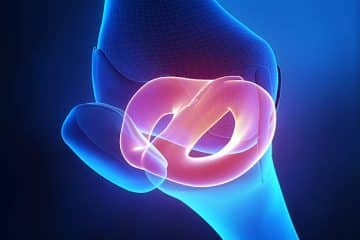 Meniscus Repair Cost