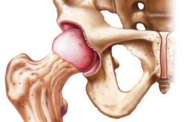 Hip Arthroscopy