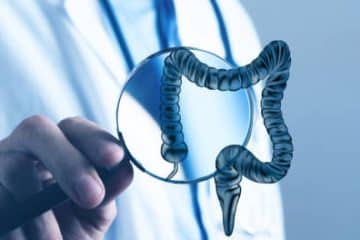 What Is Diverticulitis