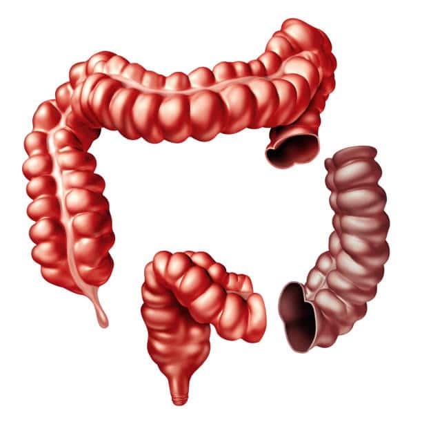 What Is Diverticulitis